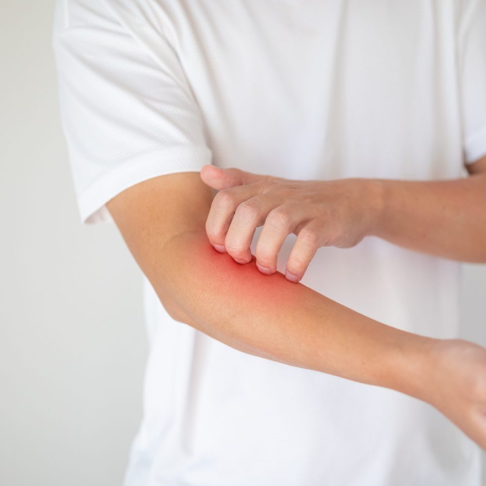 man itching and scratching on arm from itchy dry skin eczema dermatitis